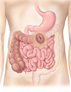 Transverse Colostomy