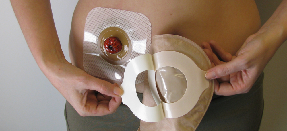 ConvaTec Esteem Synergy Versorgungswechsel Schritt f&uuml;r Schritt 06