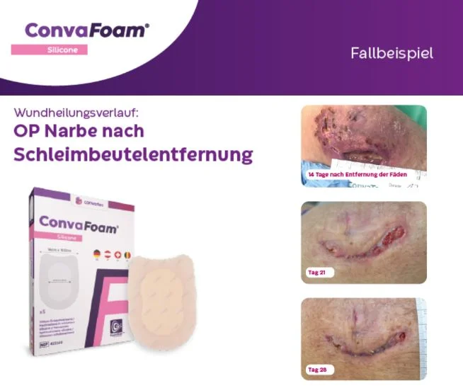 Die Abbildung zeigt den Wundheilungsverlauf einer OP-Narbe nach Schleimbeutelentfernung und die Verpackung sowie den Wundverband von ConvaFoam® Silicone.
