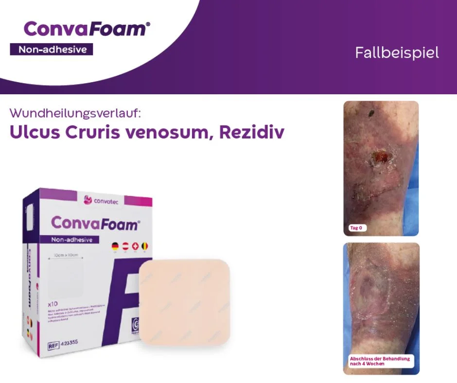 Die Abbildung zeigt den Wundheilungsverlauf eines Ulcus Cruris venosum, Rezidiv und die Verpackung sowie den Wundverband von ConvaFoam® nicht-adhäsiv.
