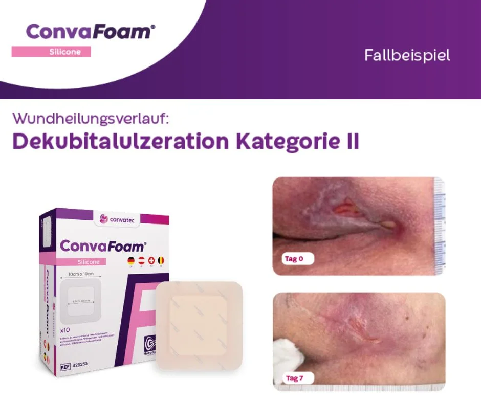 Die Abbildung zeigt den Wundheilungsverlauf einer Dekubitalulzeration Kategorie II und die Verpackung sowie den Wundverband von ConvaFoam® Silicone. 